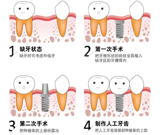 种植牙步骤图