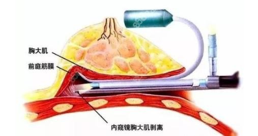 宁波艺星隆胸怎样？采用的是内窥镜假体隆胸术