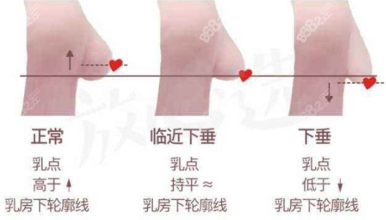 重庆华美下皱襞皮瓣乳房重建术