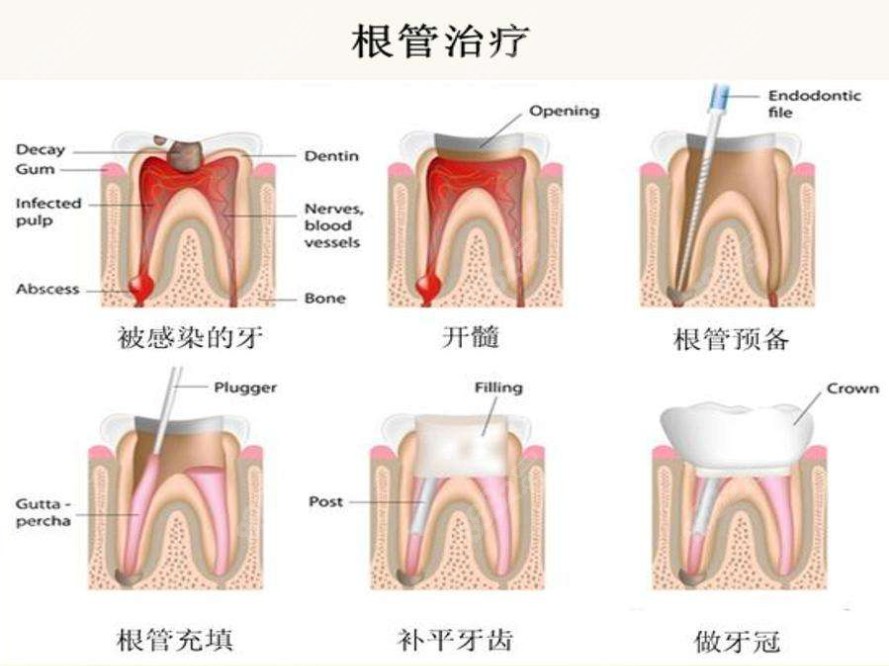 儿童根管治疗流程