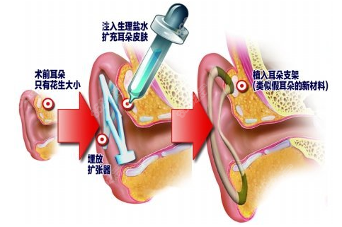 上海医生做肋软骨耳再造怎么样