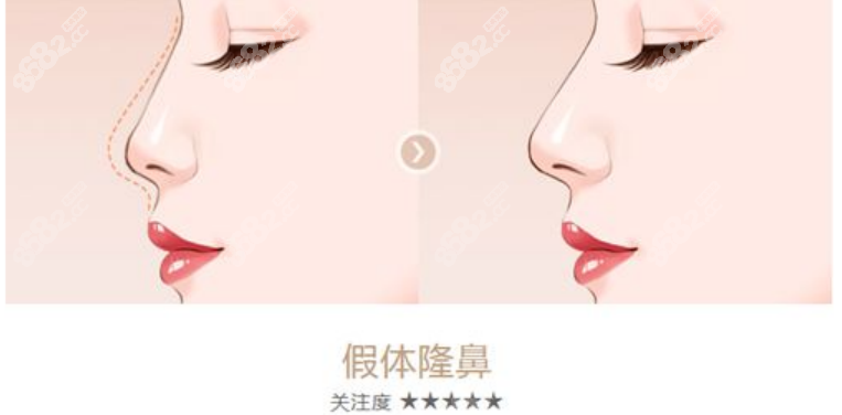 頓兆醫(yī)生做鼻子怎么樣 頓兆醫(yī)生做鼻子怎么樣
