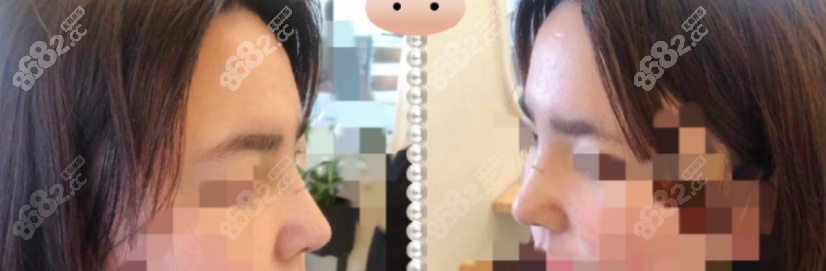 頓兆醫(yī)生隆鼻的術(shù)后樣子 頓兆醫(yī)生隆鼻的術(shù)后樣子