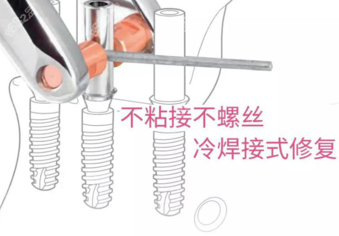 冷焊植牙技术优势