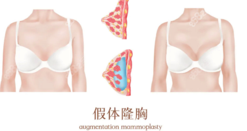 深圳南雅梁智隆胸怎么样