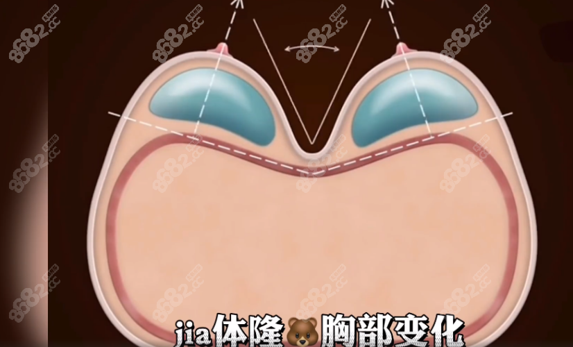 唐志荣医生做隆胸好吗？
