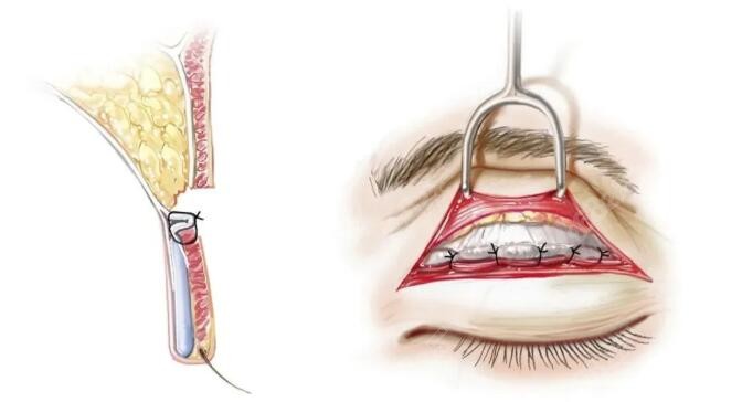 双眼皮修复怎么样