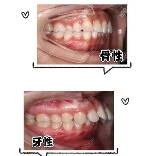 虎牙跟龅牙的区别图图片