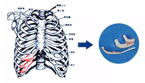 耳再造手术需要取2-3根肋软骨前端.jpg