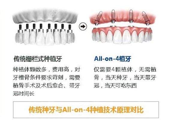 传统种植牙和allon4的区别