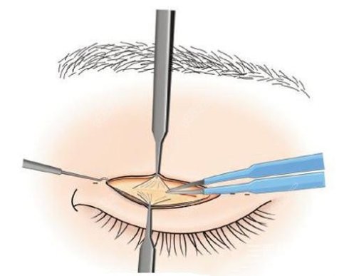 双眼皮修复价格