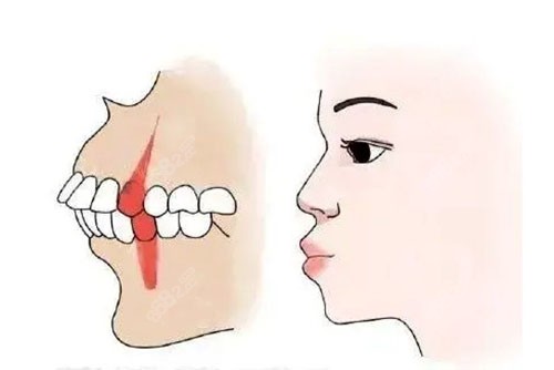 牙性龅牙侧脸图片