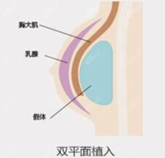 双平面假体植入技术优势