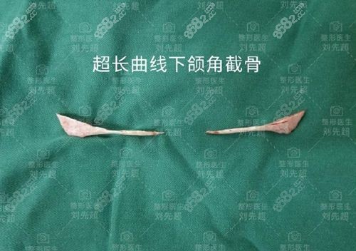 医院下颌角截骨