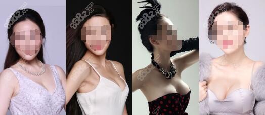 长沙雅美医院假体隆胸