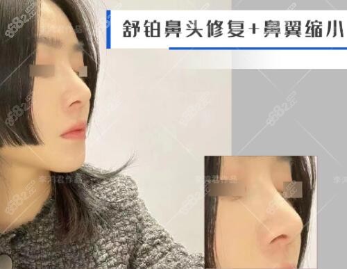 李鸿君鼻修复术后