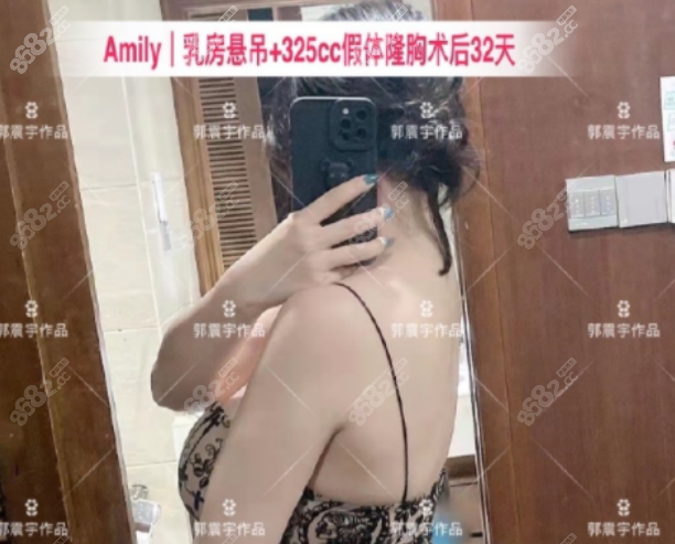 广州郭震宇隆胸