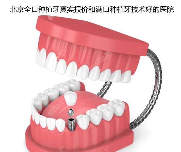 北京全口种植牙真实报价和满口种植牙技术好的医院