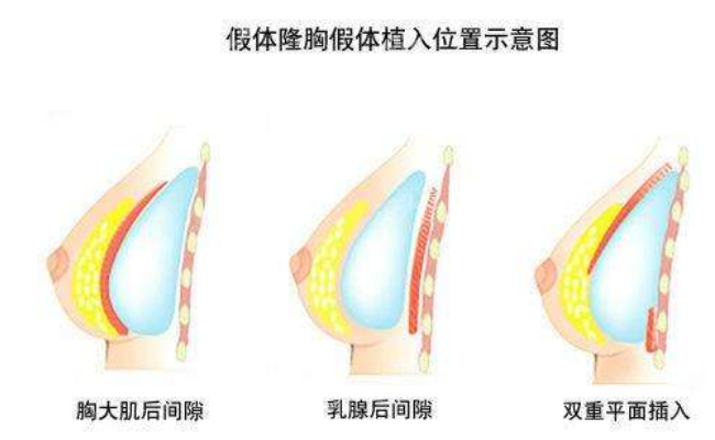 广州郭震宇隆胸做的好吗