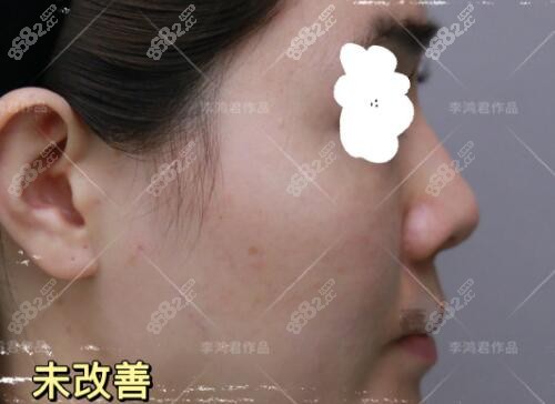 李鸿君鼻修复前