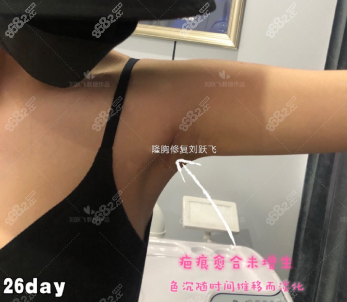 刘跃飞医生做隆胸手术的后的样子