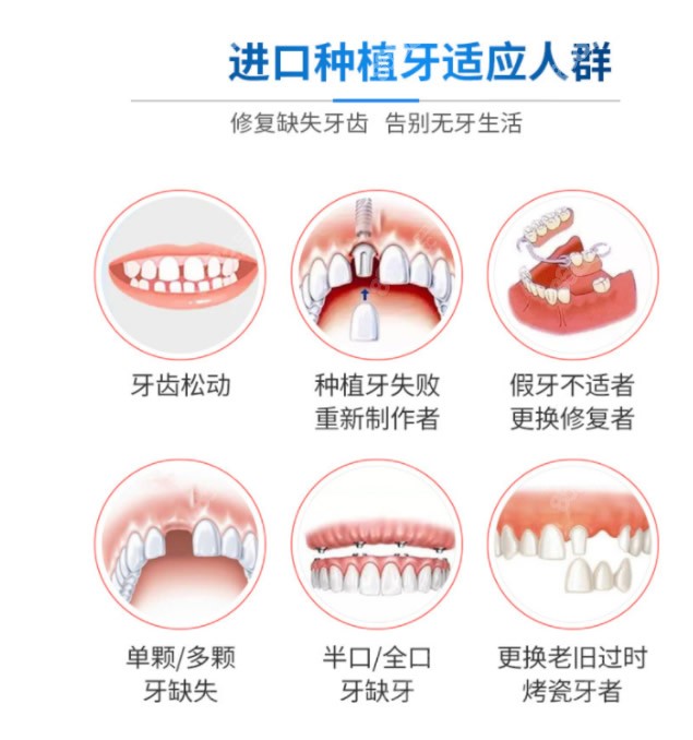 种植牙适合的人群