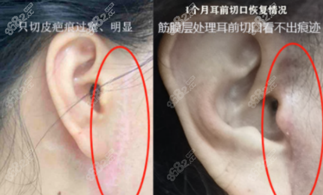 贾振华医生做拉皮手术