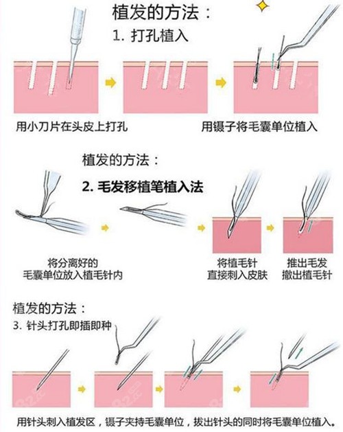 芜湖伊莱美植发技术