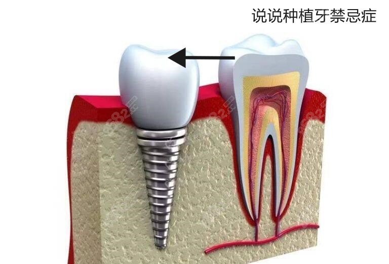 说一说种植牙禁忌症