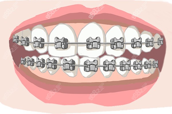 东莞矫正带牙套的收费
