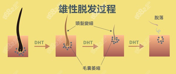 DHT(双氢睾酮)是导致脱发的元凶