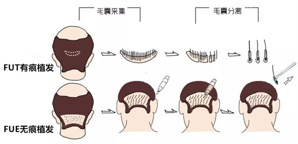 合肥曙光医院FUT与FUE植发之间的区别