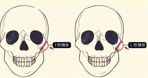 颧骨截骨方式