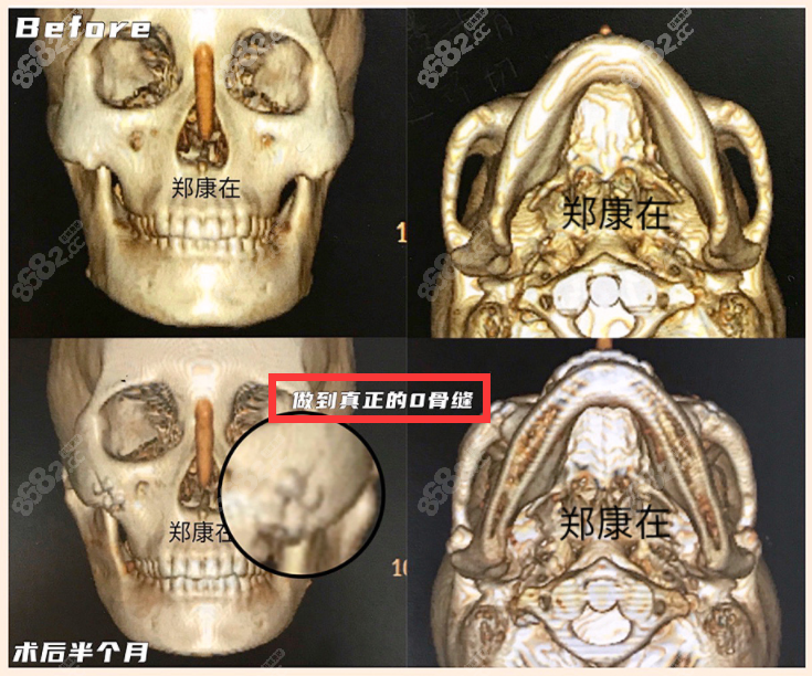 郑康在院长做的颧骨整形0骨缝