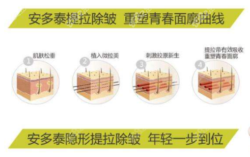 西安美莱微拉美面部提升技术