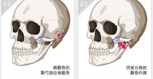 柳超院长颧骨手术