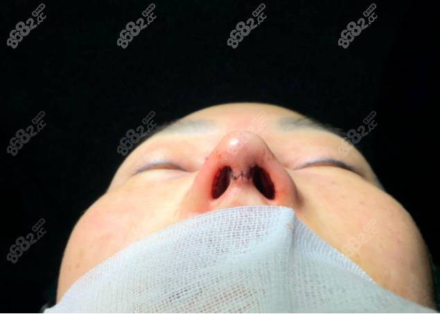 导致三庭比例严 重失衡,而且鼻基底还凹陷,鼻孔有轻微的漏出,呈现八字