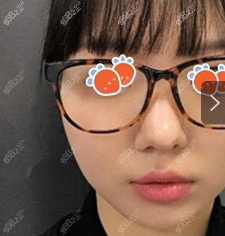 付国友磨骨术后