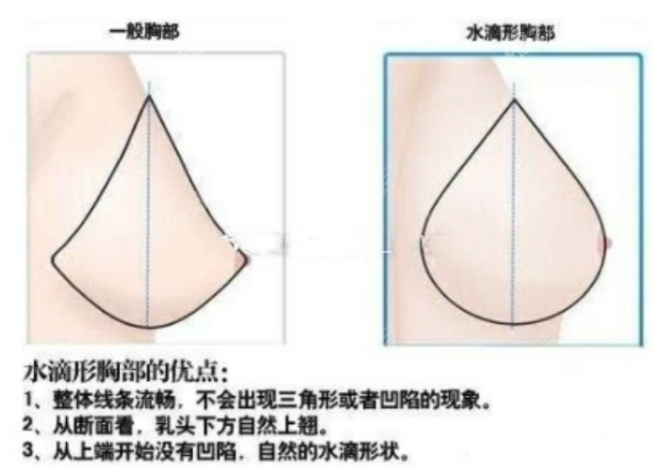 陳飛春醫(yī)生隆胸