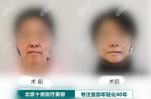 北京美媛荟李晓东拉皮手术前后对比照