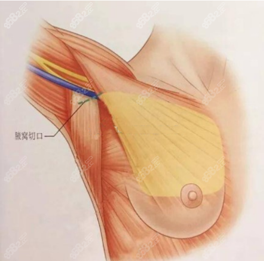 陳飛春醫(yī)生隆胸