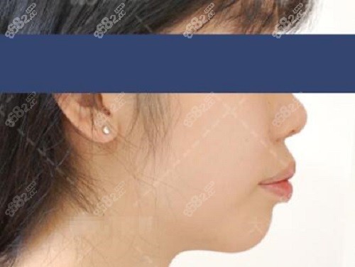 孙丹阳牙齿矫正前