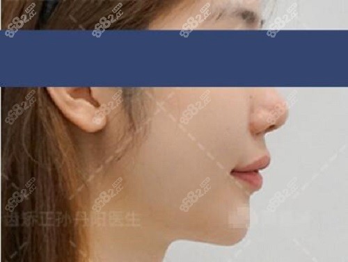 孙丹阳牙齿矫正后