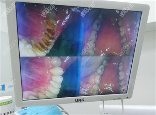 西安诺贝尔牙科洁牙