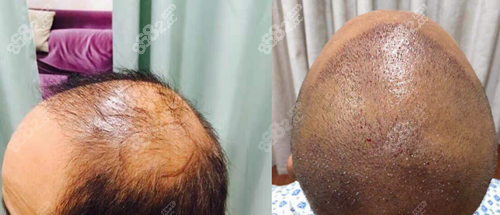 <!--<i data=20240705-sp></i>-->植發(fā)好嗎