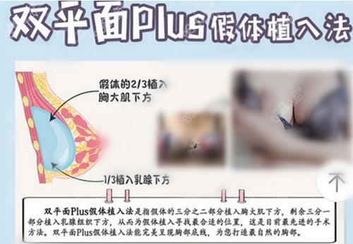韓國NANA黃銅淵隆胸技術(shù)介紹