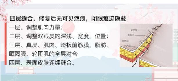 上海杜园园修复双眼皮技术优势