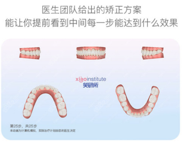 笑研所隱形矯正手術(shù)