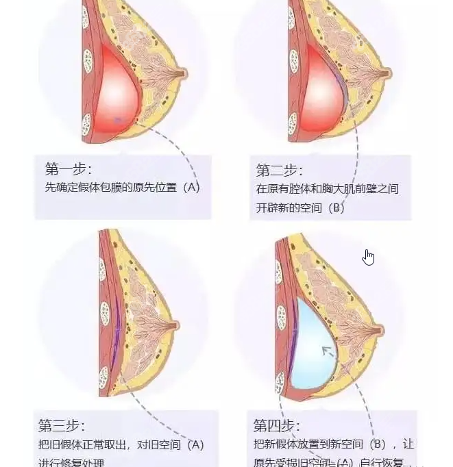 假体隆胸取出具体操作步骤