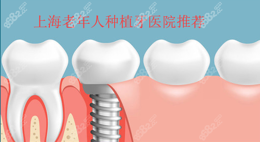 上海老年人种植牙医院推荐
